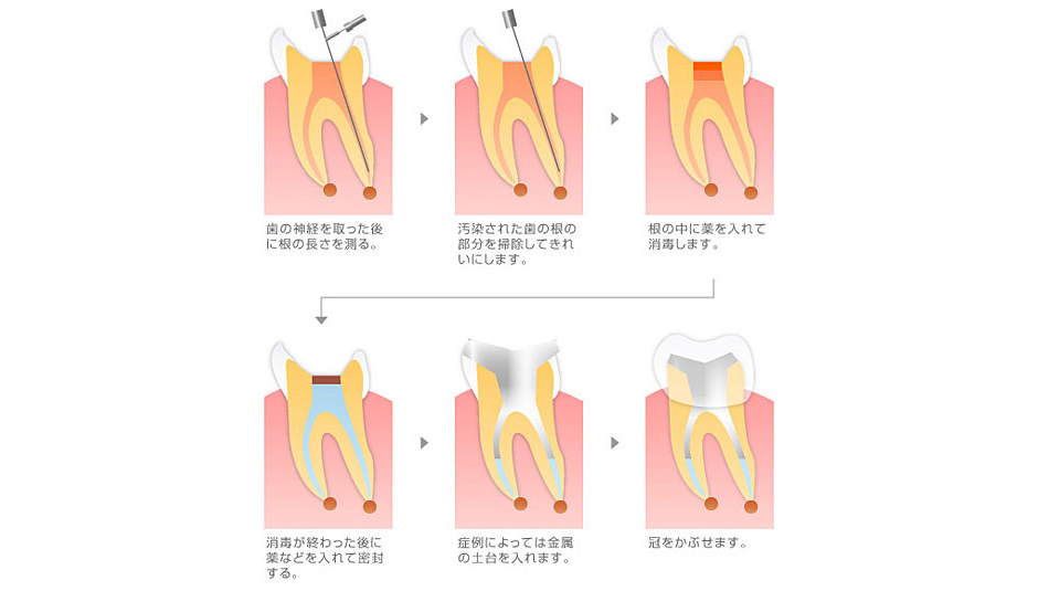 重度の虫歯治療～根管治療～