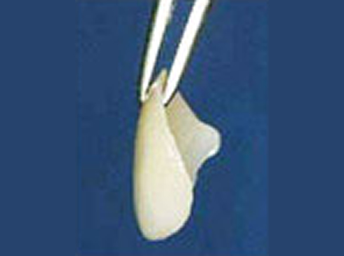 歯の表面に貼りつけるラミネートベニア