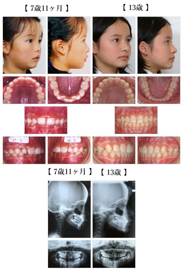 症例紹介 - 顎顔面口腔育成研究会 (JACG)
