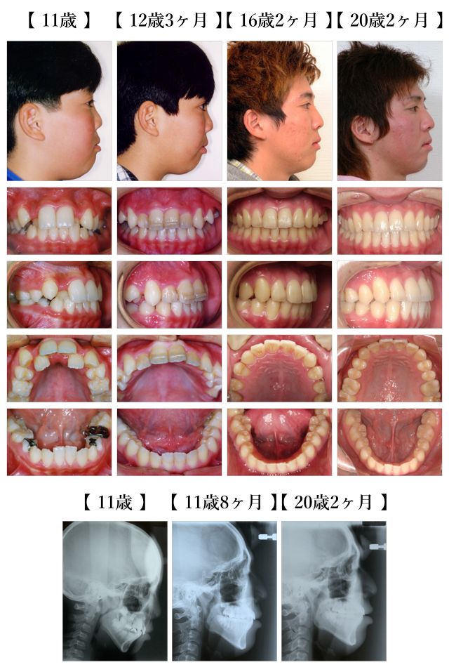 症例紹介 - 顎顔面口腔育成研究会 (JACG)