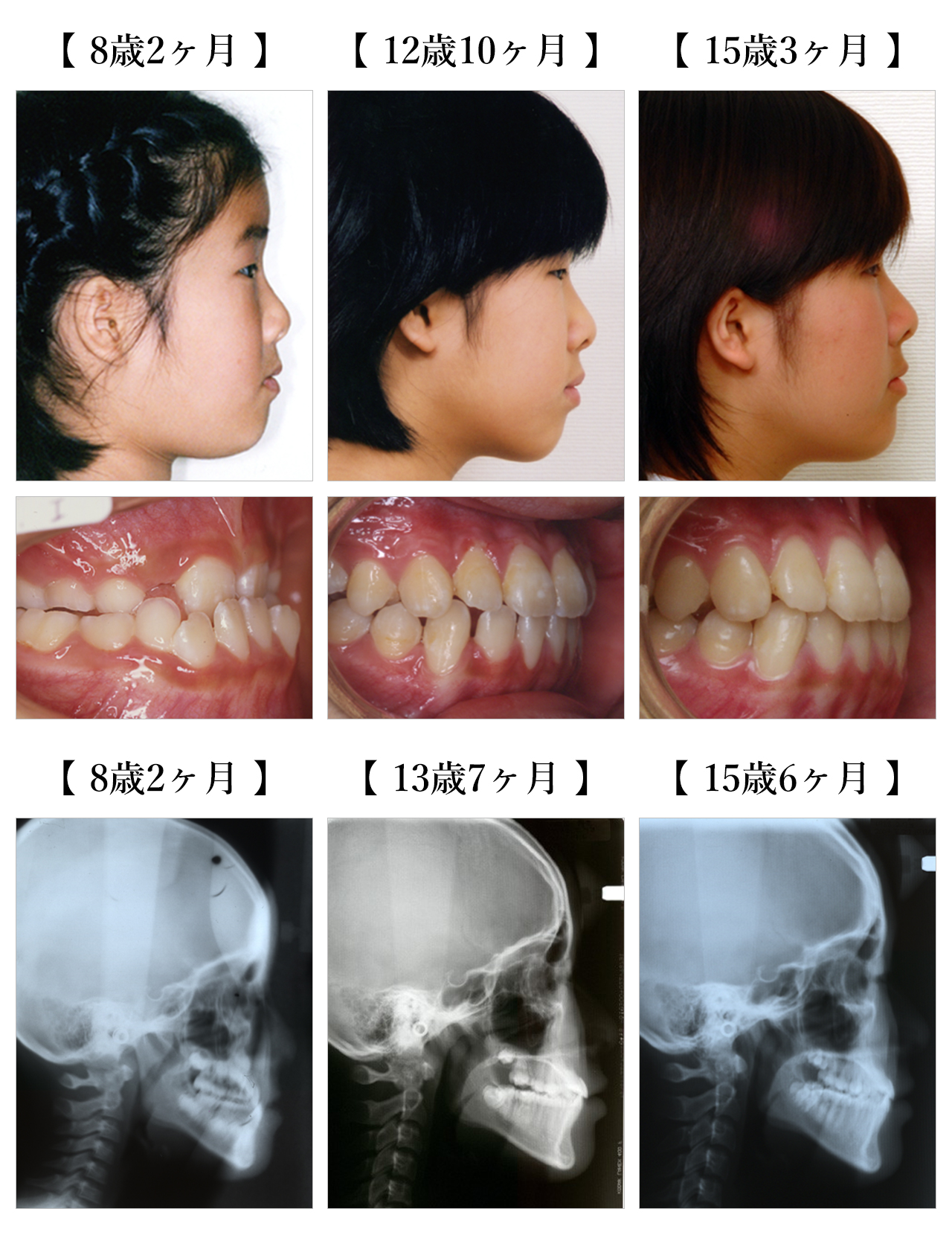 8歳2ヶ月 女児